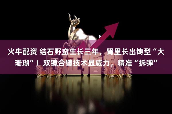 火牛配资 结石野蛮生长三年，肾里长出铸型“大珊瑚”！双镜合璧技术显威力，精准“拆弹”